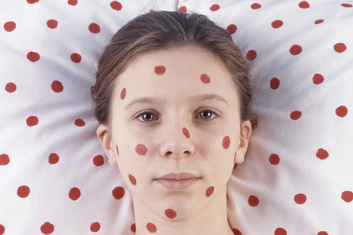 О профилактике кори