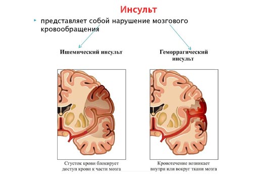 Как победить инсульт