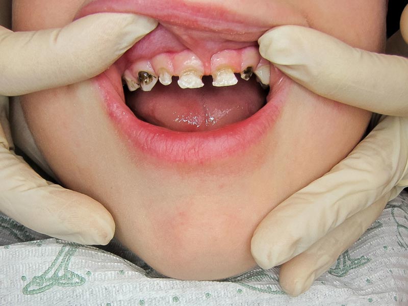 Профилактика кариеса у детей