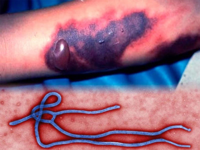 Профилактика лихорадки Эбола