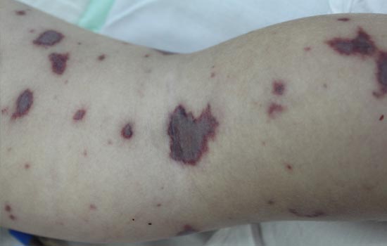 Менингококковая инфекция