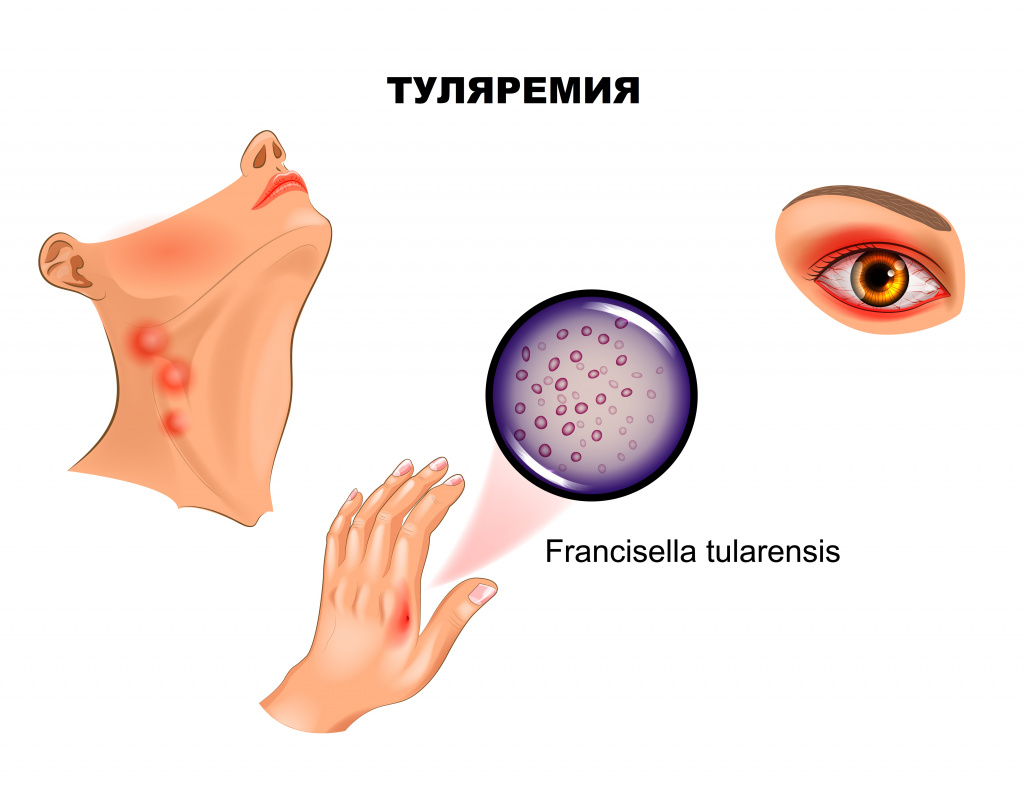 Туляремия - информация о заболевании