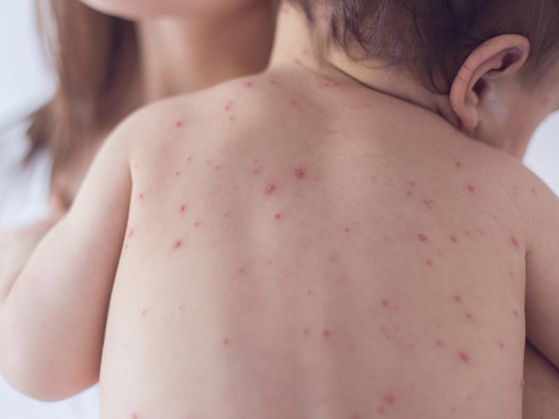 Зарегистрированы случаи КОРИ