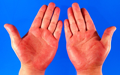 О профилактике иерсиниоза